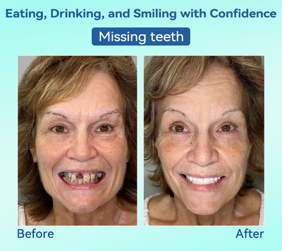 FlexiSmile Dentures - A Secure Smile, A Youthful Face + 50% OFF