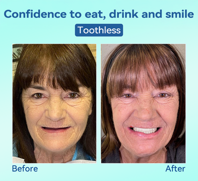 FlexiSmile Dentures - A Secure Smile, A Youthful Face + 50% OFF