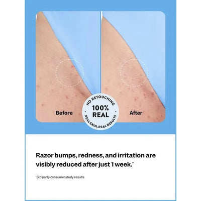 DermaCalm - The End of Ingrown Hairs & Razor Bumps - 50% OFF