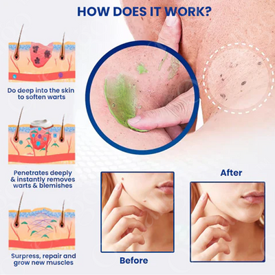 ClearGlow Instant Mole & Spot Removal Gel – Reveal Smooth, Radiant Skin Naturally - 50% OFF
