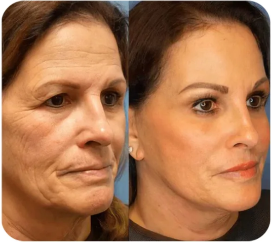 DermaSculpt Lifting & Firming Serum – Visible Tightening, Youthful Glow - 50% OFF