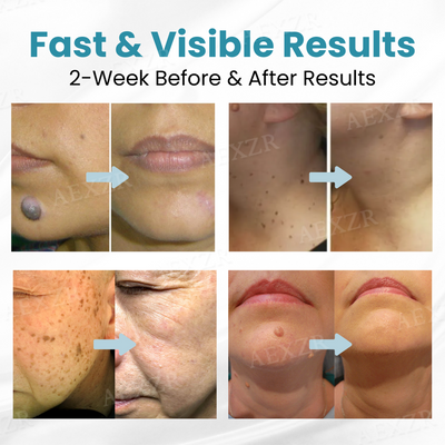 SkinRenew Pro Laser Pen - Non-Invasive Mole & Wart Removal Tool – 50% OFF
