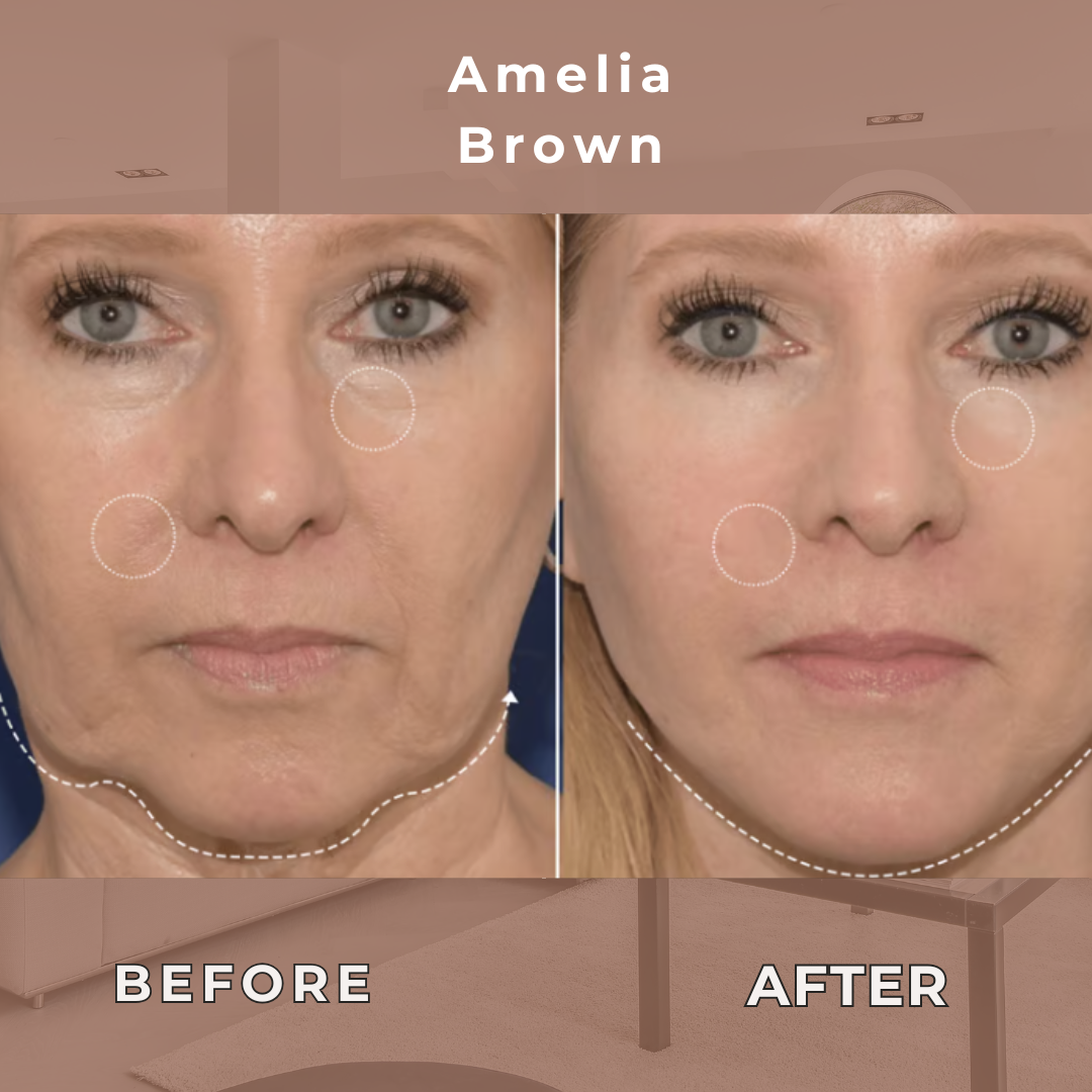 LiftRenew Instant Lift Patches – Your Secret to Timeless Confidence - 50% OFF
