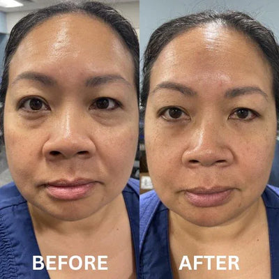 CryoGlow Patches - A Camera-Ready Look in 60 Minutes - 50% OFF