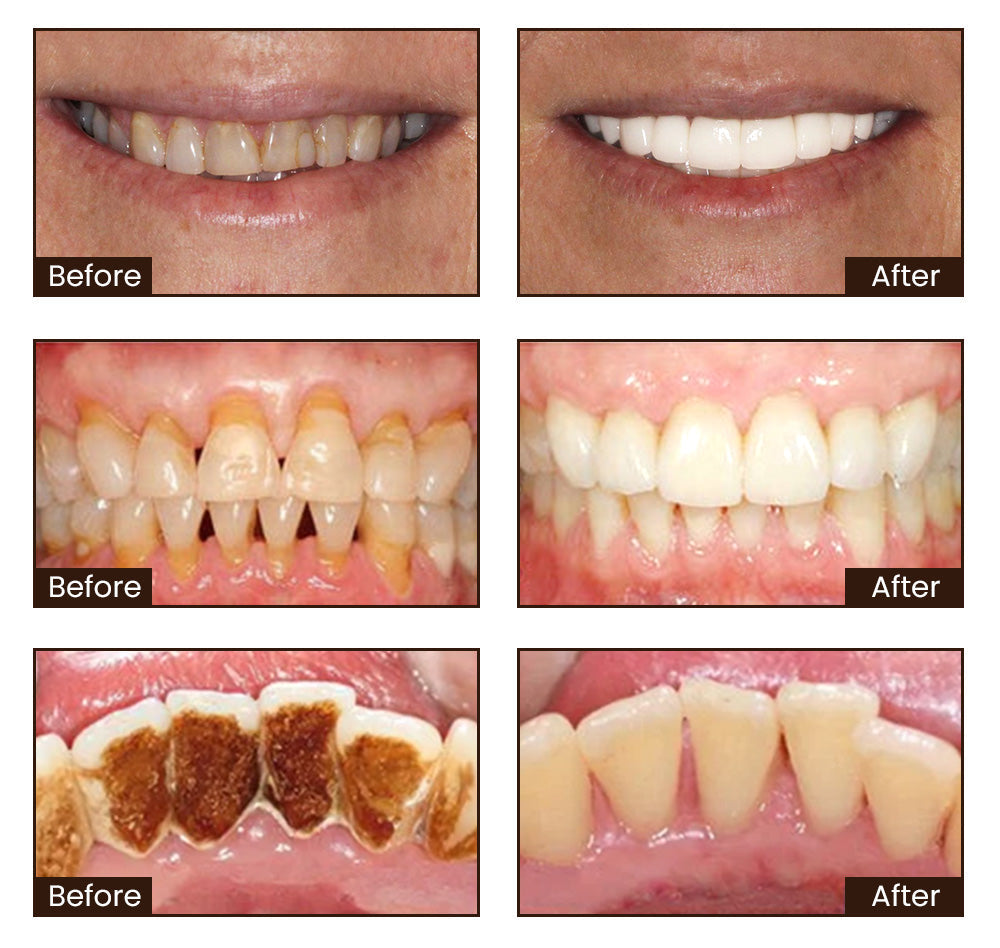 Pro-Denta Elixir - Restore Your Youthful Smile - BUY 1 GET 1 FREE