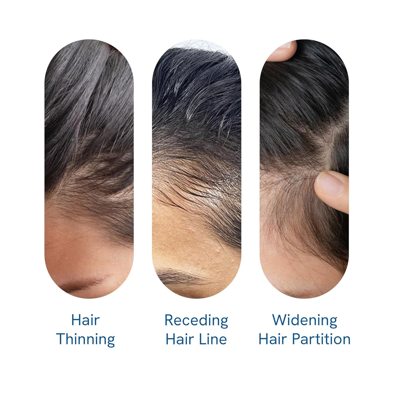 FolliRevive - Reawaken Your Hair Follicles - 50% OFF