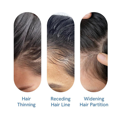 FolliRevive - Reawaken Your Hair Follicles - 50% OFF