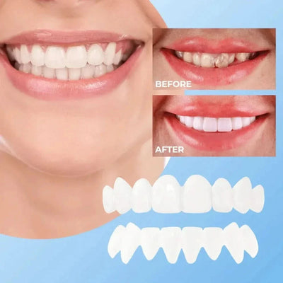 Instant Smile Veneers – Natural White Finish Removable Design - 50% OFF