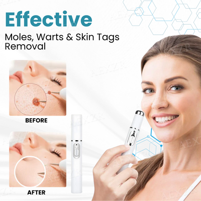 SkinRenew Pro Laser Pen - Non-Invasive Mole & Wart Removal Tool – 50% OFF