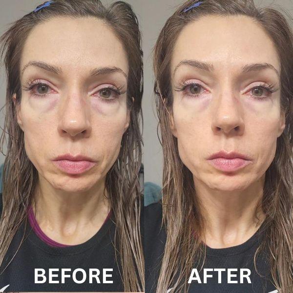 CryoGlow Patches - A Camera-Ready Look in 60 Minutes - 50% OFF