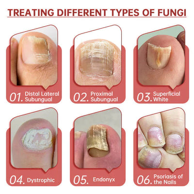 FungaClear Triple-Action Nail Repair - Clear Nails, Renewed Confidence + 1+1 FREE