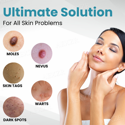 SkinRenew Pro Laser Pen - Non-Invasive Mole & Wart Removal Tool – 50% OFF