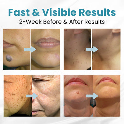 DermaZap - Flawless Skin, No Scars, No Surgery - 50% OFF