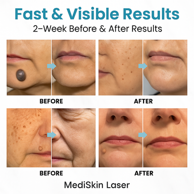 DermaPure Pro + Clear Skin, Renewed Confidence - 60% OFF