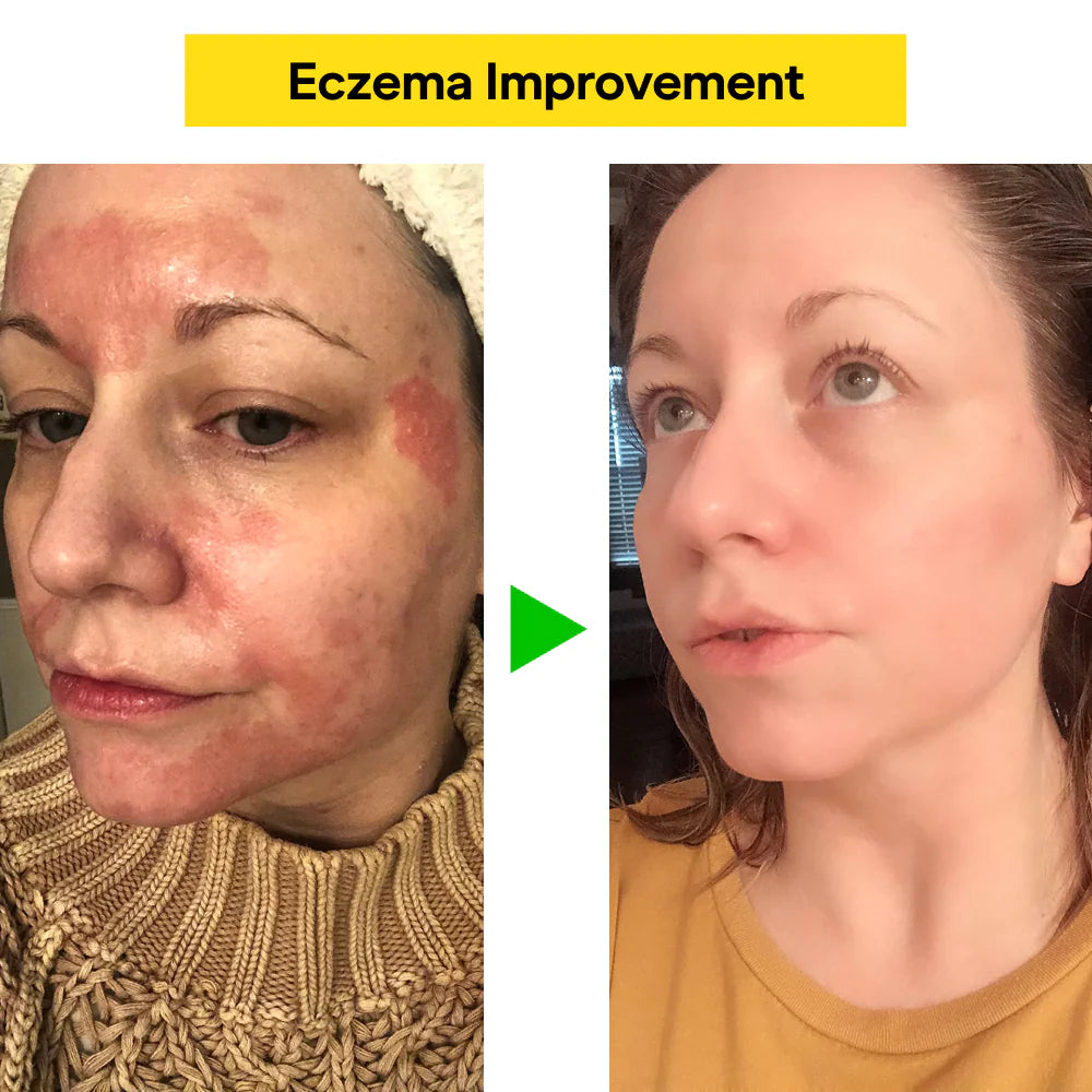 DermaCalm Balm - End the Itch, Heal Your Skin - 50% OFF