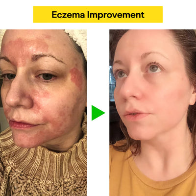 DermaCalm Balm - End the Itch, Heal Your Skin - 50% OFF