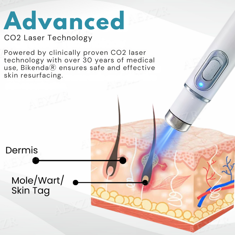 SkinRenew Pro Laser Pen - Non-Invasive Mole & Wart Removal Tool – 50% OFF