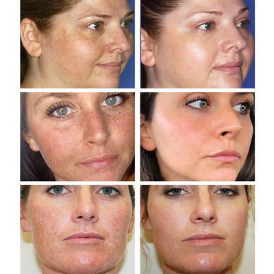AuraRenew Blemish Cream - Erase Spots & Wrinkles - 50% OFF