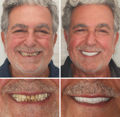 Comfort-Fit Flexible Dentures – Natural Look Easy Wear & Removal - 50% OFF