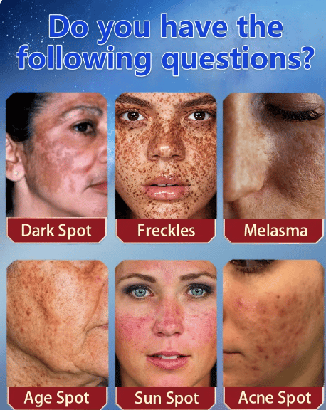 AuraRenew Blemish Cream - Erase Spots & Wrinkles - 50% OFF
