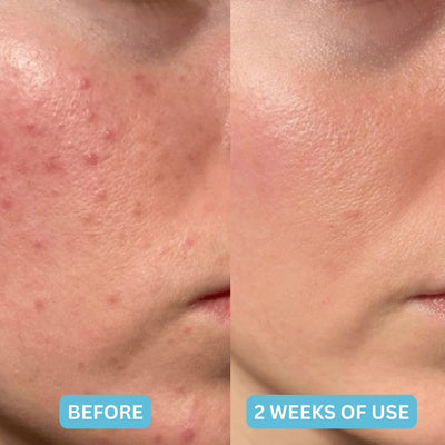 The Hydrocolloid Pimple Patch - A Blemish-Free Look, Overnight + 50% OFF