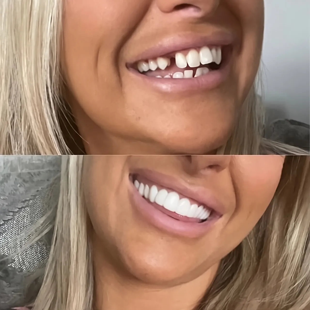 Instant Smile Veneers – Natural White Finish Removable Design - 50% OFF